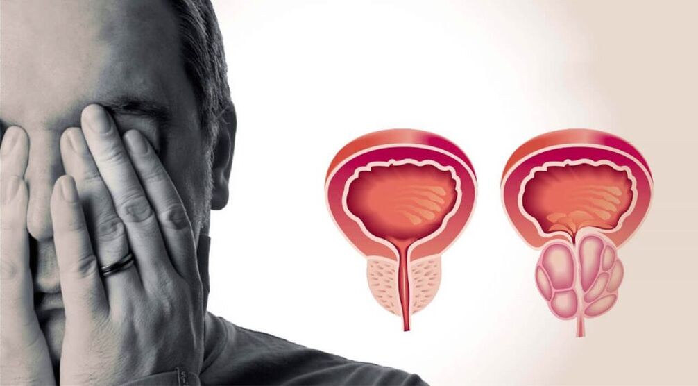 hogyan lehet megtudni a prosztatagyulladást a férfiaknál önállóan kezelt krónikus prosztatagyulladás
